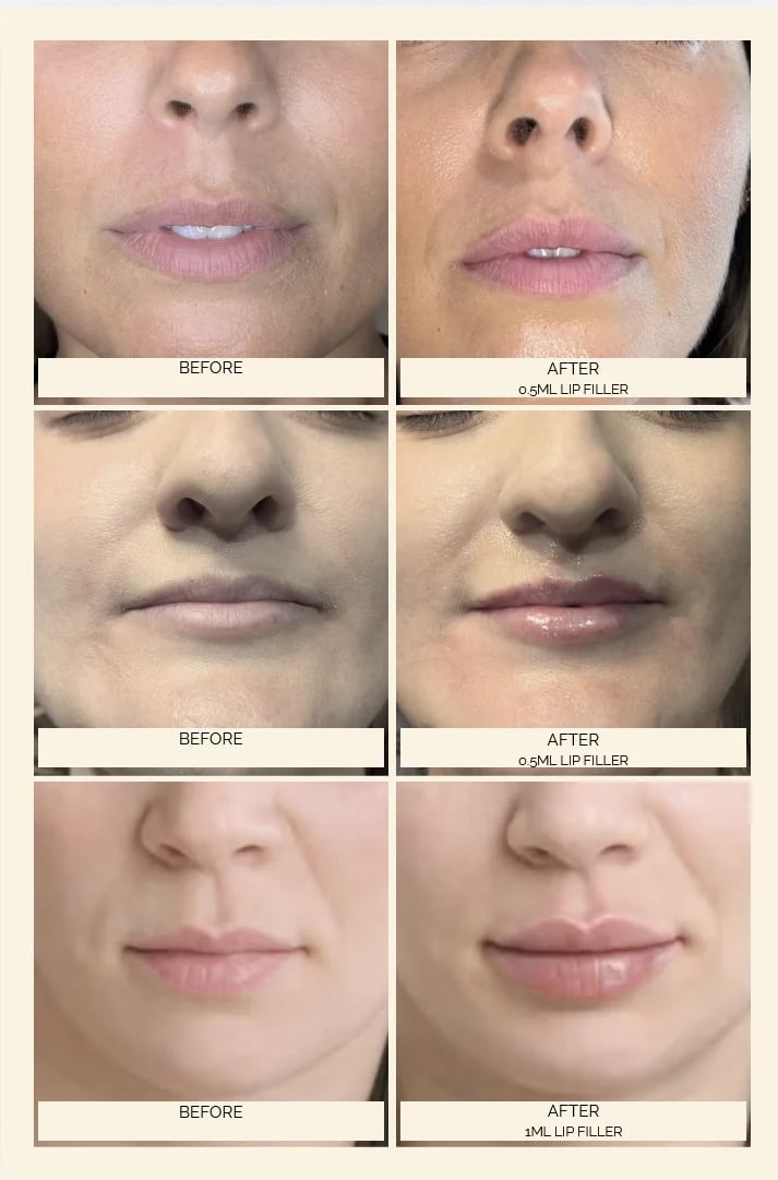 Before and after comparison of lip filler treatments on three different patients showing fuller lips and enhanced lip definition