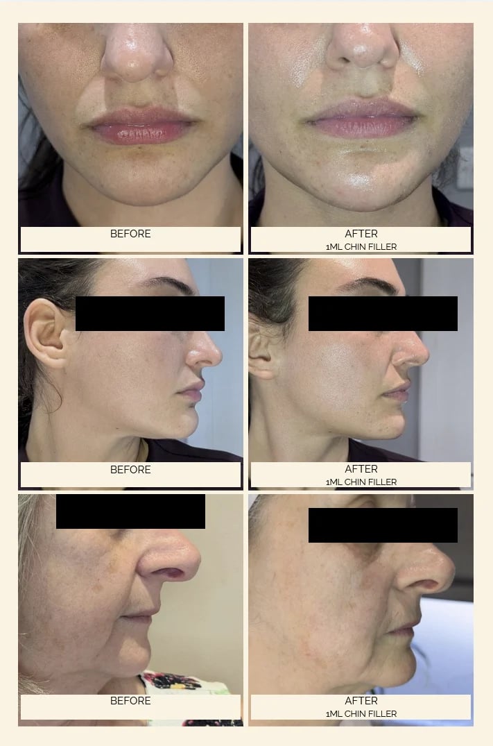 Before and after comparison of chin filler treatment showing front and side profile views of facial enhancement results