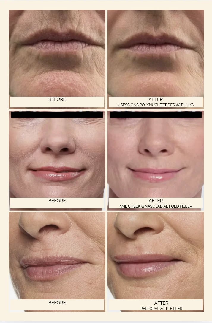 Before and after comparison of facial treatments showing skin rejuvenation around lips, cheeks, and mouth area